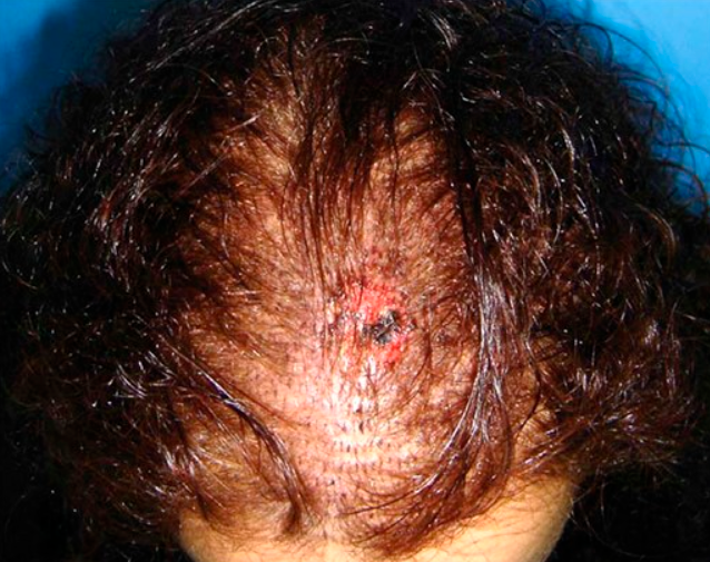 Surgical Complications in Hair Transplantation A Series of 533 Procedures